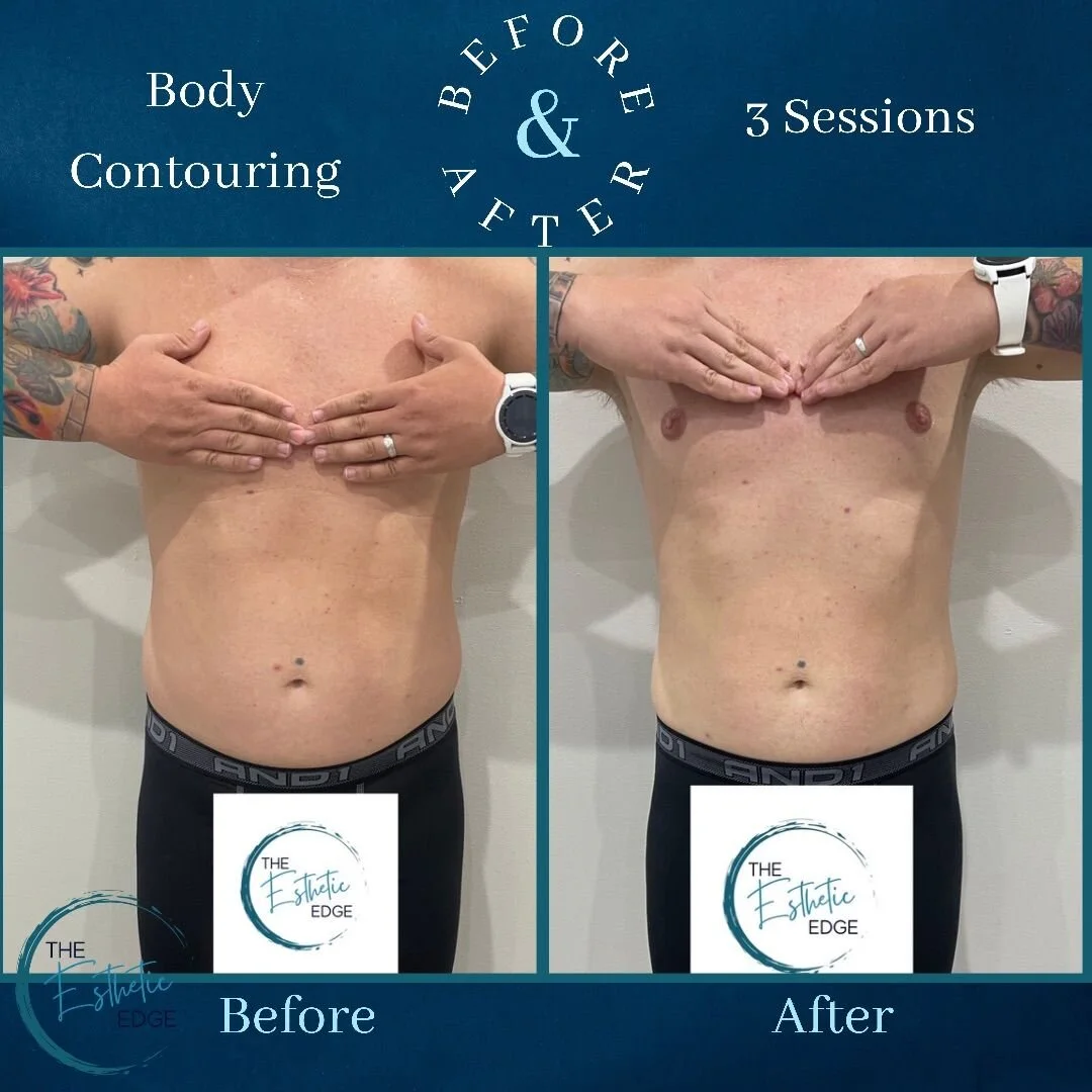 Before and After Body Contouring Photos Louisville Lymphatic Center